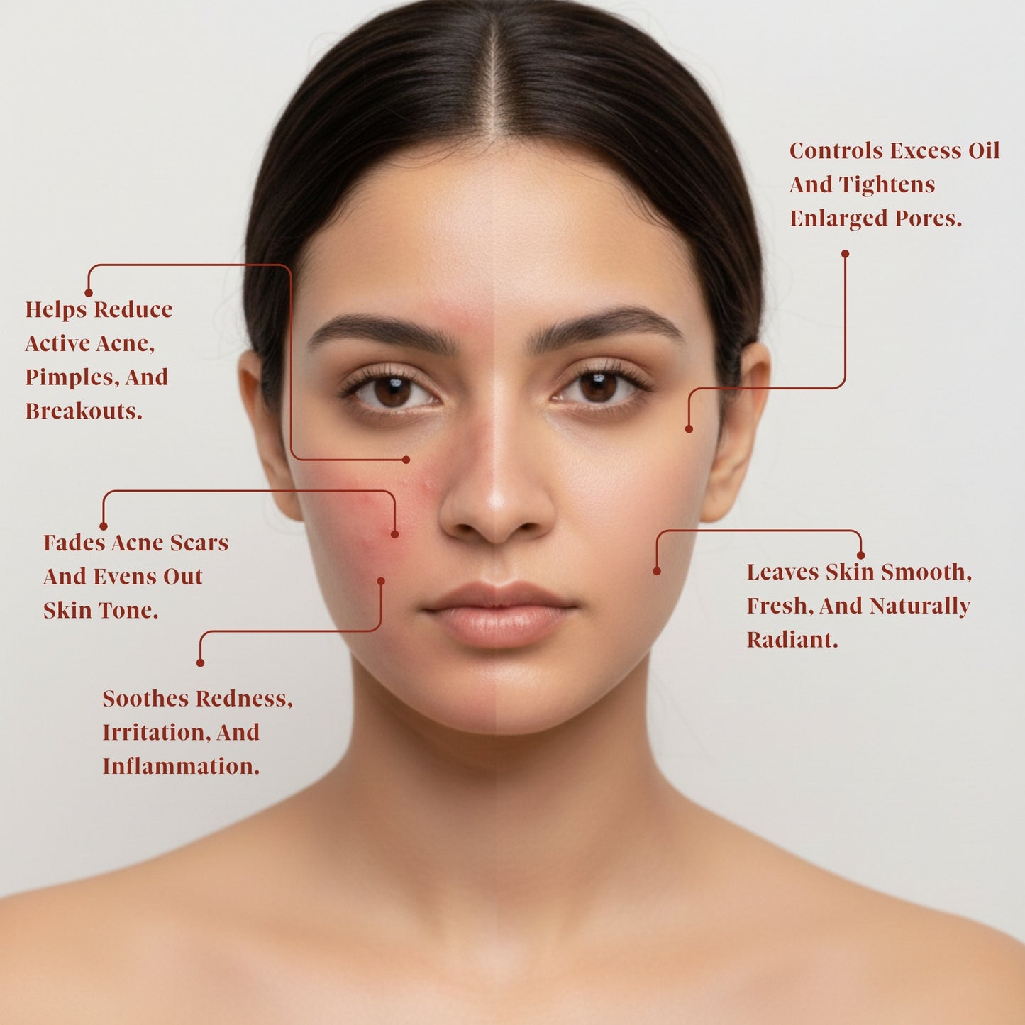 Ishna Anti-acne Face Pack