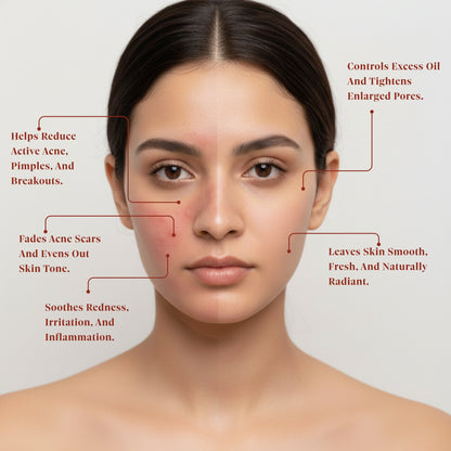 Ishna Anti-acne Face Pack